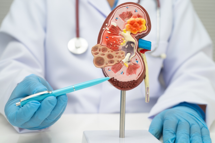 Kidney Stones